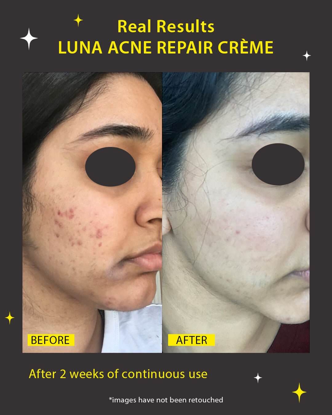 Luna Acne Repair Crème
