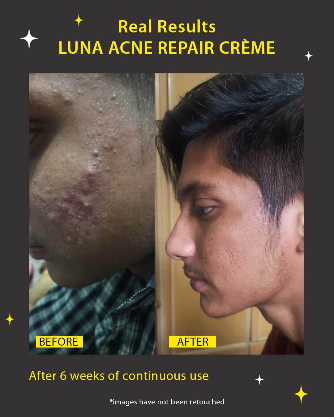 Luna Acne Repair Crème